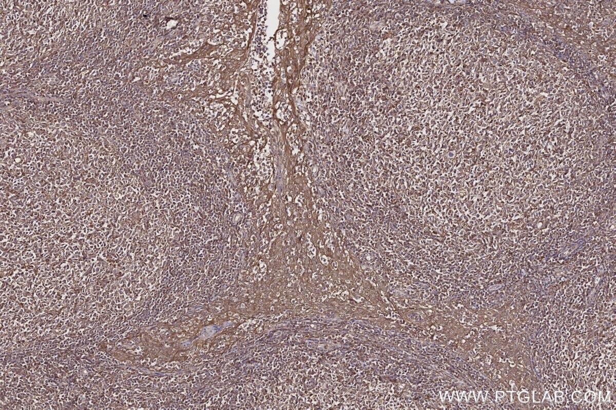 Immunohistochemical analysis of paraffin-embedded human tonsillitis tissue slide using KHC2709 (PIP4K2C IHC Kit).