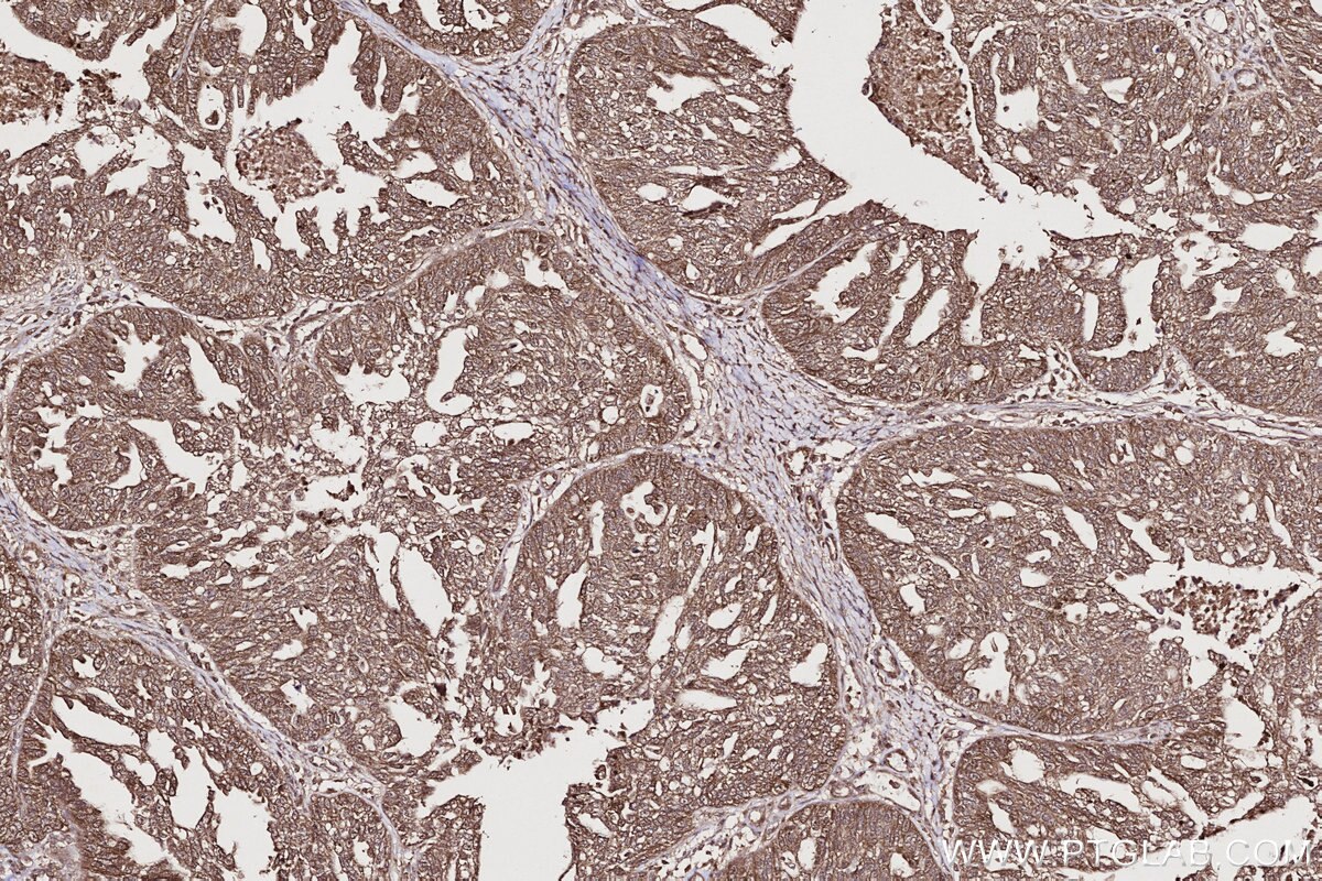 Immunohistochemical analysis of paraffin-embedded human ovary cancer tissue slide using KHC2709 (PIP4K2C IHC Kit).