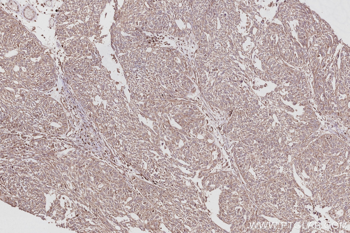 Immunohistochemical analysis of paraffin-embedded human ovary cancer tissue slide using KHC3054 (PIP5K3 IHC Kit). Immunohistochemical analysis of paraffin-embedded human ovary cancer tissue slide using KHC3054 (PIP5K3 IHC Kit).