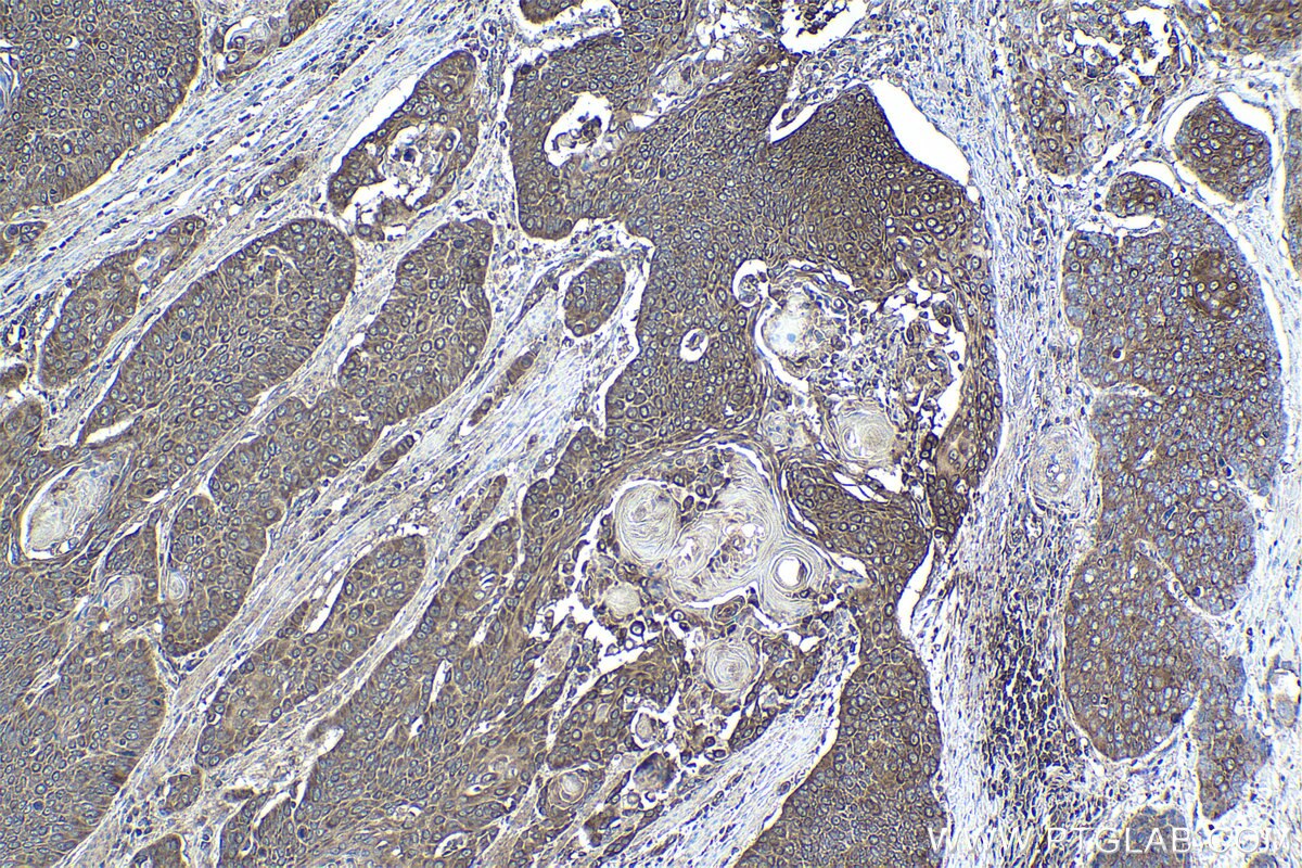 Immunohistochemical analysis of paraffin-embedded human oesophagus cancer tissue slide using KHC0984 (PITPNA IHC Kit).