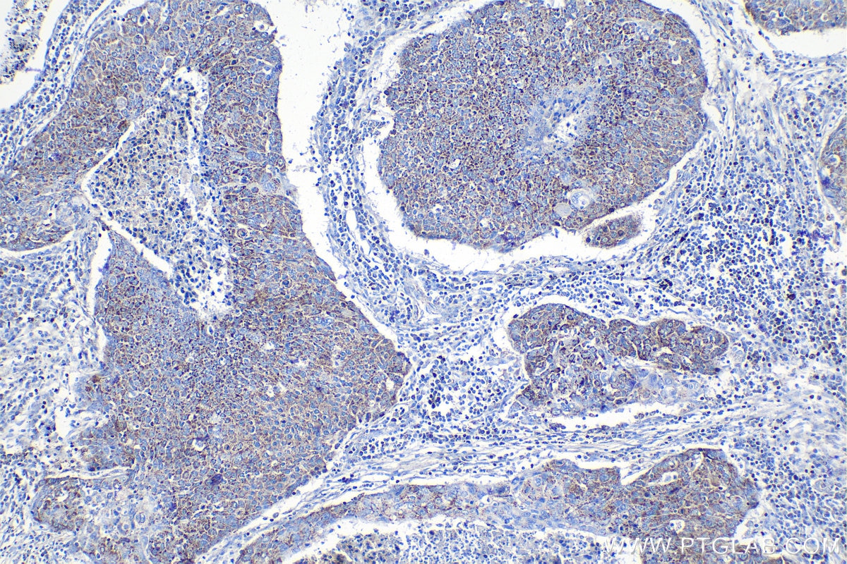 Immunohistochemical analysis of paraffin-embedded human lung cancer tissue slide using KHC1370 (PITRM1 IHC Kit).