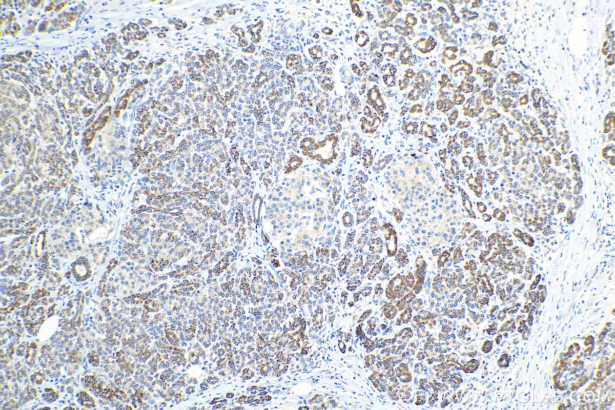 Immunohistochemical analysis of paraffin-embedded human pancreas cancer tissue slide using KHC1515 (PKHD1 IHC Kit).