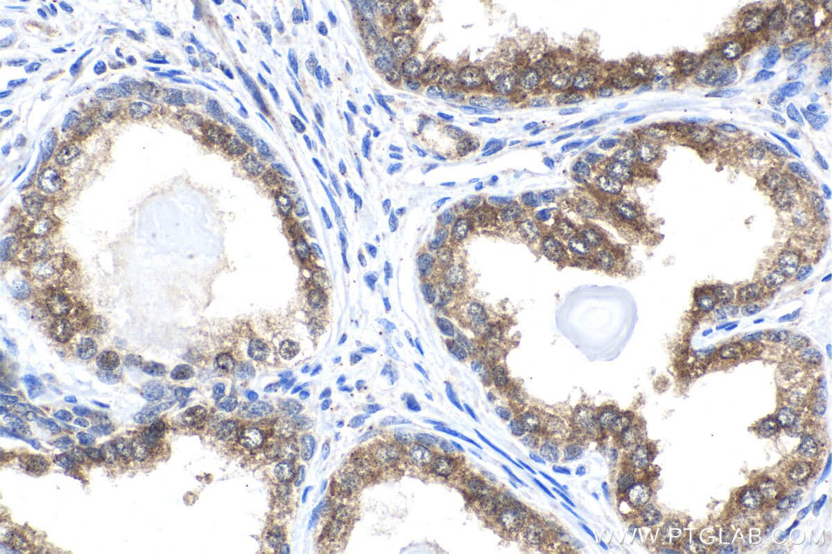 Immunohistochemical analysis of paraffin-embedded human prostate cancer tissue slide using KHC1515 (PKHD1 IHC Kit).