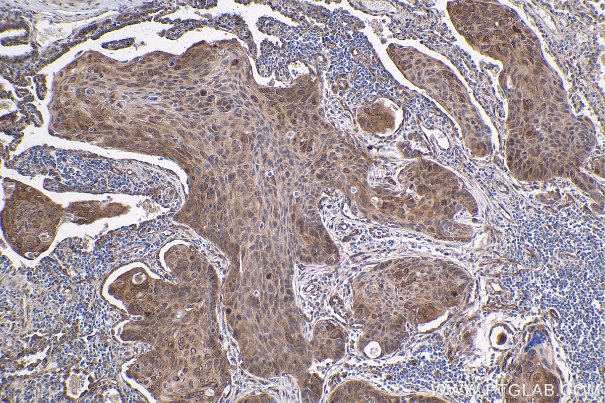 Immunohistochemical analysis of paraffin-embedded human lung cancer tissue slide using KHC1758 (PKN2 IHC Kit).