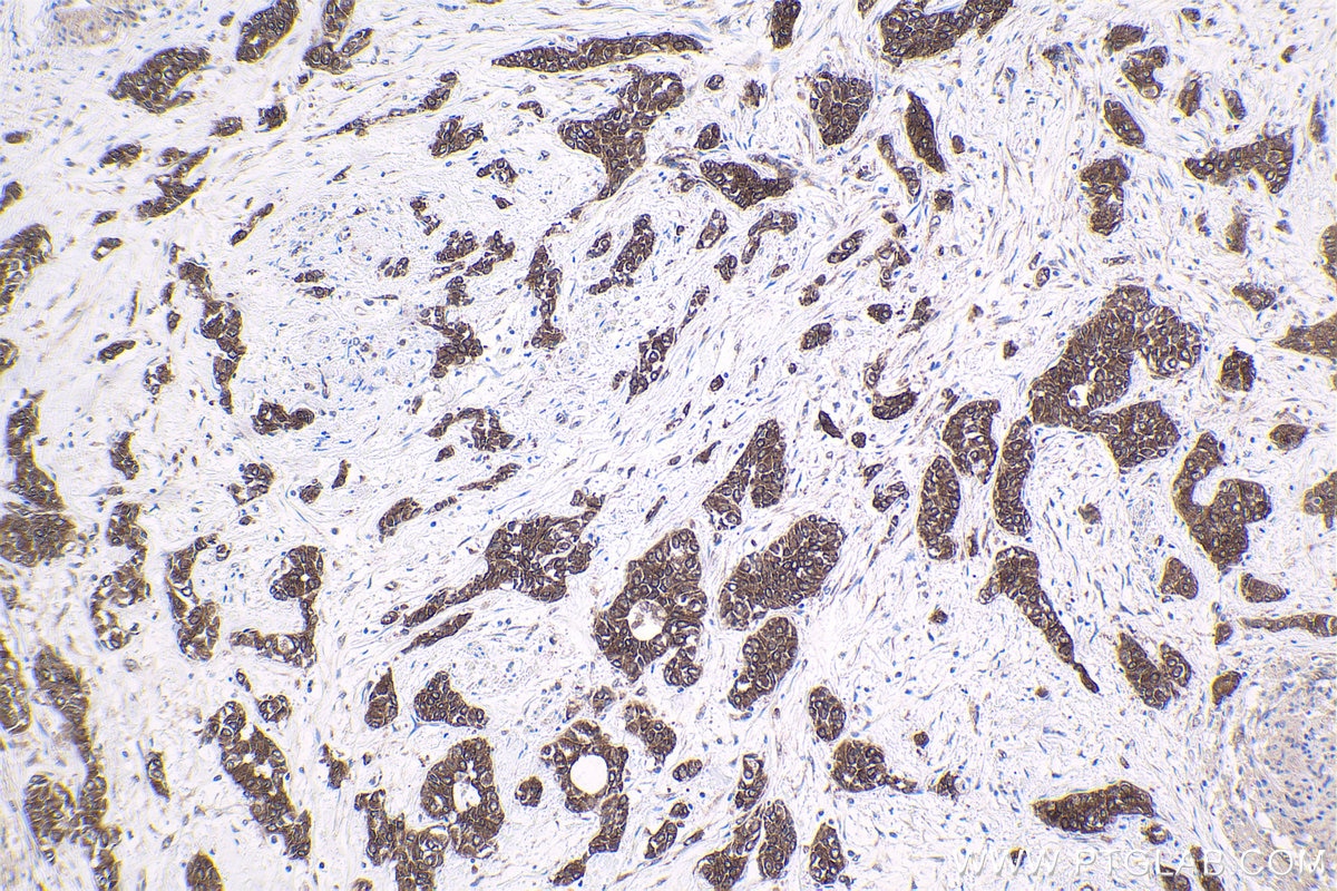 Immunohistochemical analysis of paraffin-embedded human urothelial carcinoma tissue slide using KHC1758 (PKN2 IHC Kit).