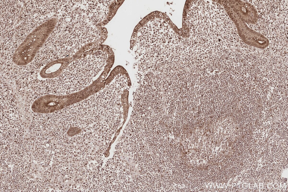 Immunohistochemical analysis of paraffin-embedded human appendicitis tissue slide using KHC2851 (PKP2 IHC Kit).
