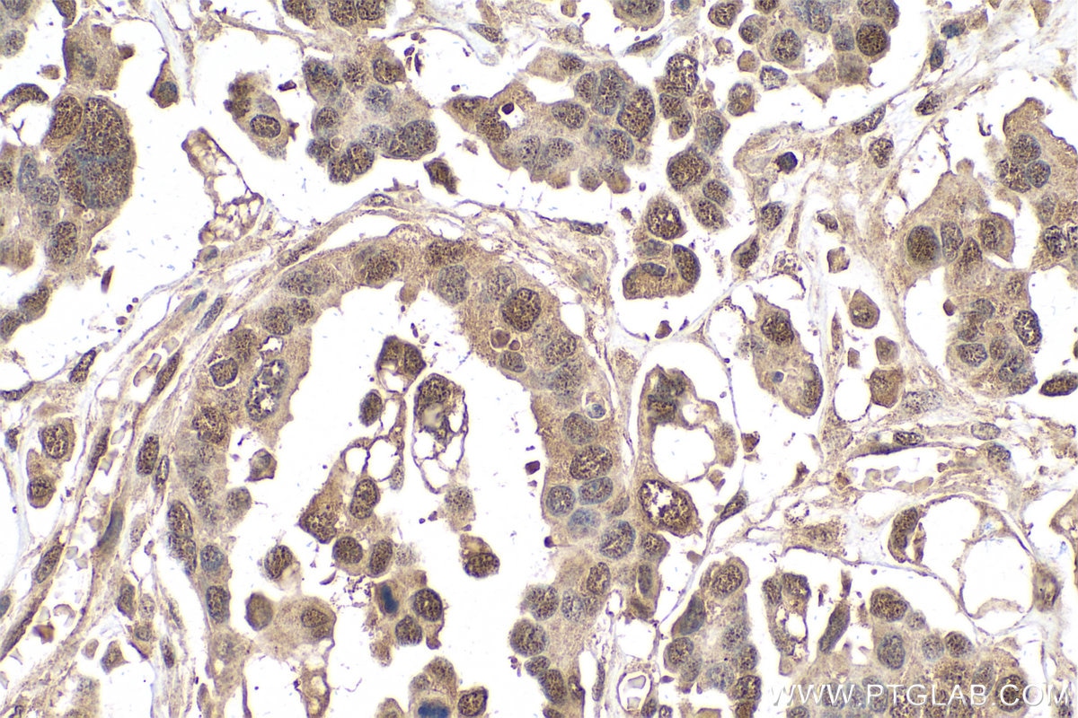 Immunohistochemical analysis of paraffin-embedded human colon cancer tissue slide using KHC0774 (PLAA IHC Kit).