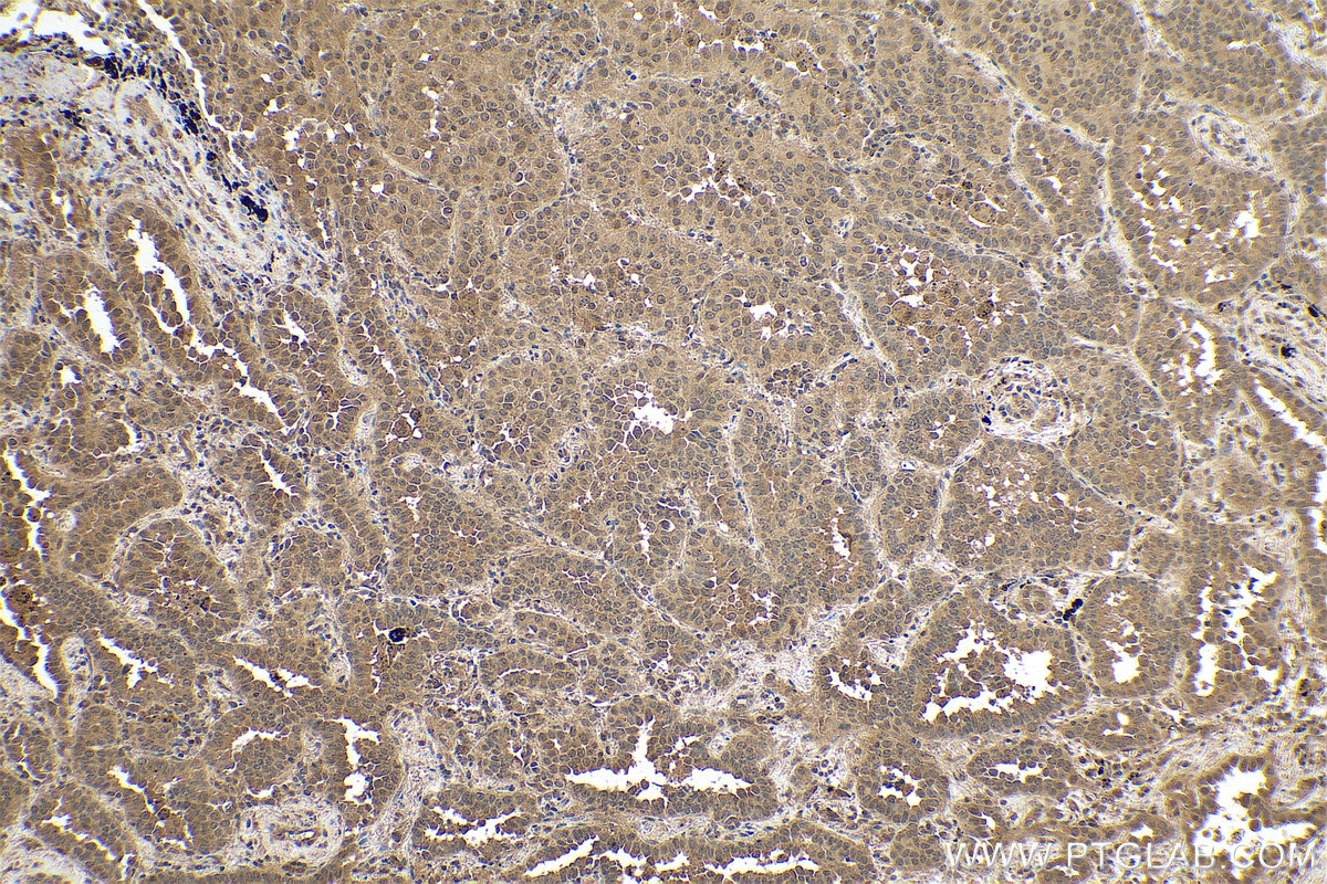 Immunohistochemical analysis of paraffin-embedded human lung cancer tissue slide using KHC0774 (PLAA IHC Kit).