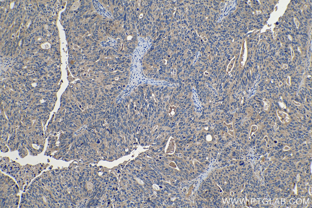 Immunohistochemical analysis of paraffin-embedded human ovary tumor tissue slide using KHC1210 (PLAT IHC Kit).