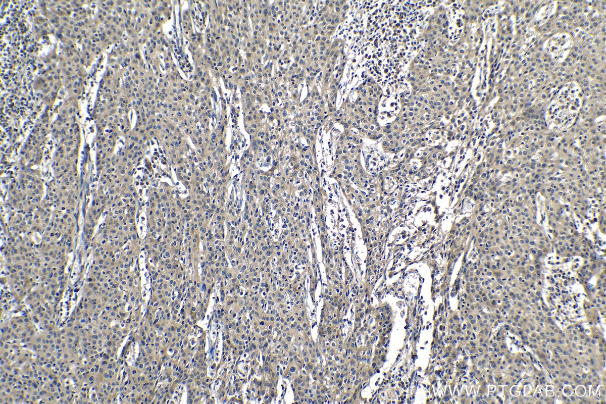Immunohistochemical analysis of paraffin-embedded human cervical cancer tissue slide using KHC1210 (PLAT IHC Kit).