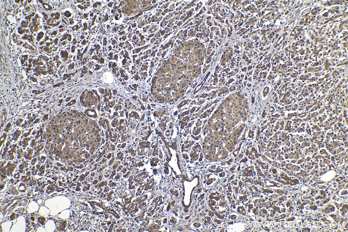 Immunohistochemical analysis of paraffin-embedded human pancreas cancer tissue slide using KHC1210 (PLAT IHC Kit).