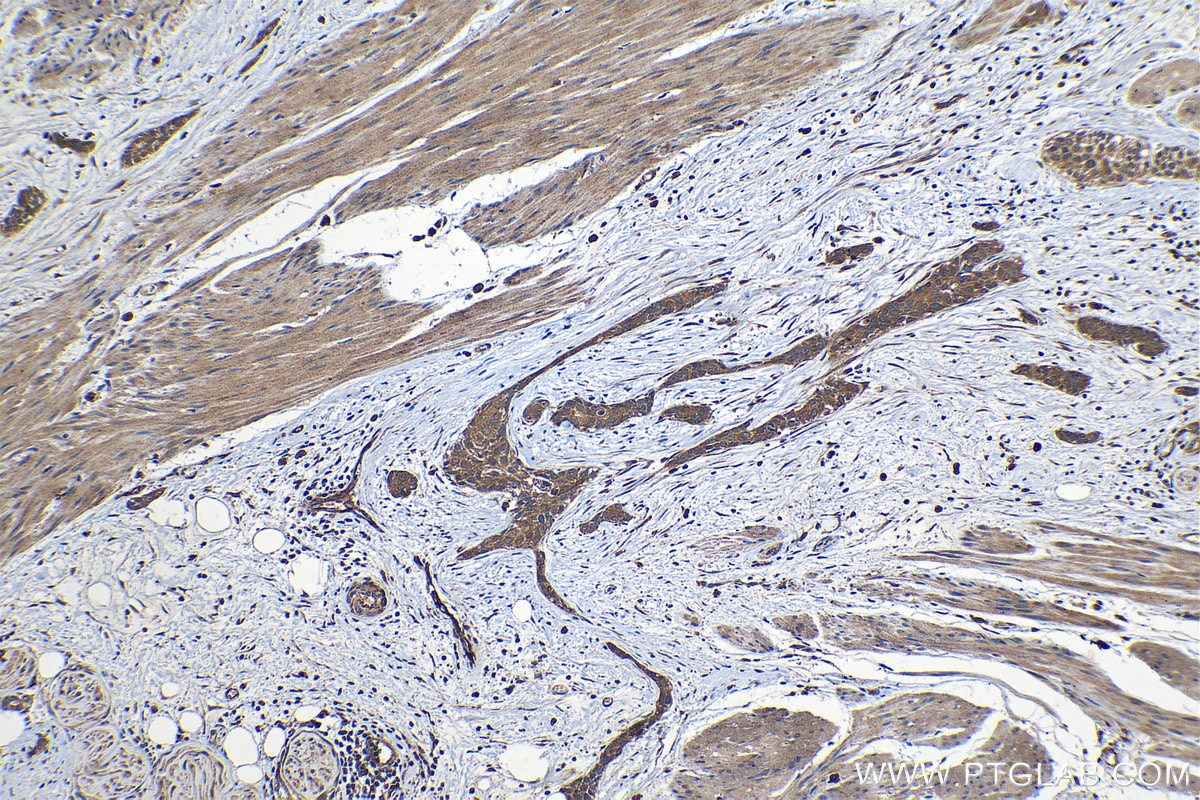 Immunohistochemical analysis of paraffin-embedded human urothelial carcinoma tissue slide using KHC1210 (PLAT IHC Kit).