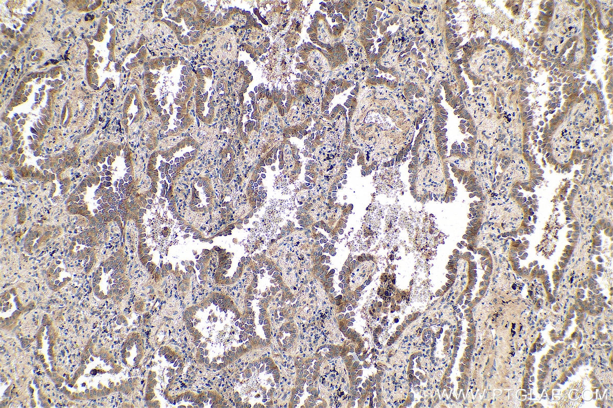 Immunohistochemical analysis of paraffin-embedded human lung cancer tissue slide using KHC0598 (Phospholipase C epsilon 1 IHC Kit).