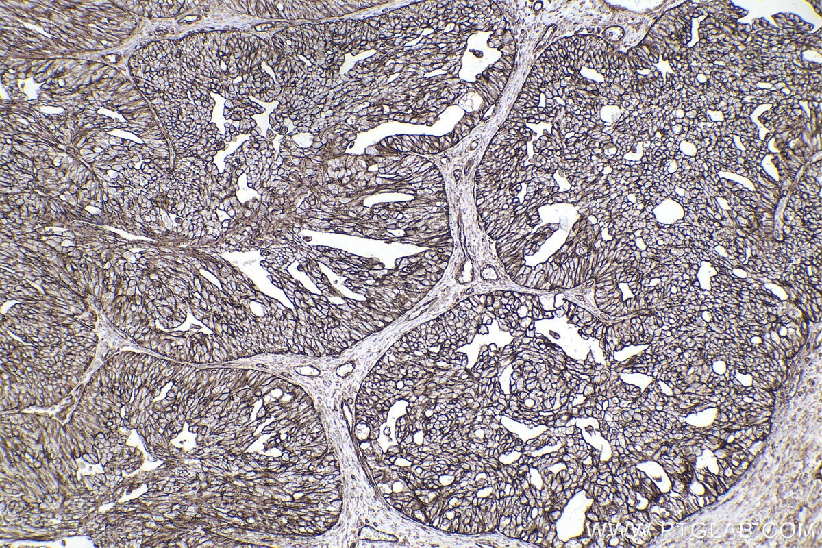 Immunohistochemical analysis of paraffin-embedded human ovary cancer tissue slide using KHC2482 (PLEC IHC Kit).