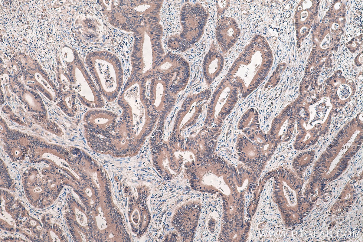 Immunohistochemical analysis of paraffin-embedded human colon cancer tissue slide using KHC0445 (PLEK2 IHC Kit).