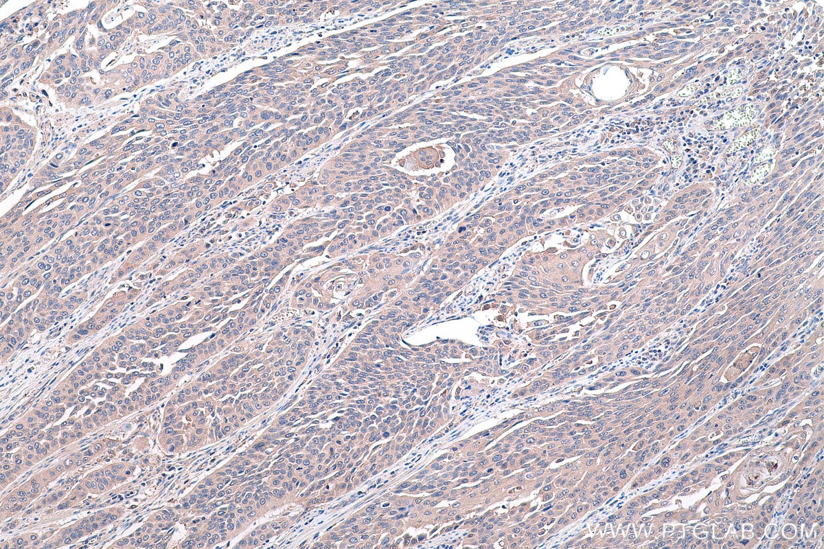 Immunohistochemical analysis of paraffin-embedded human oesophagus cancer tissue slide using KHC0445 (PLEK2 IHC Kit).