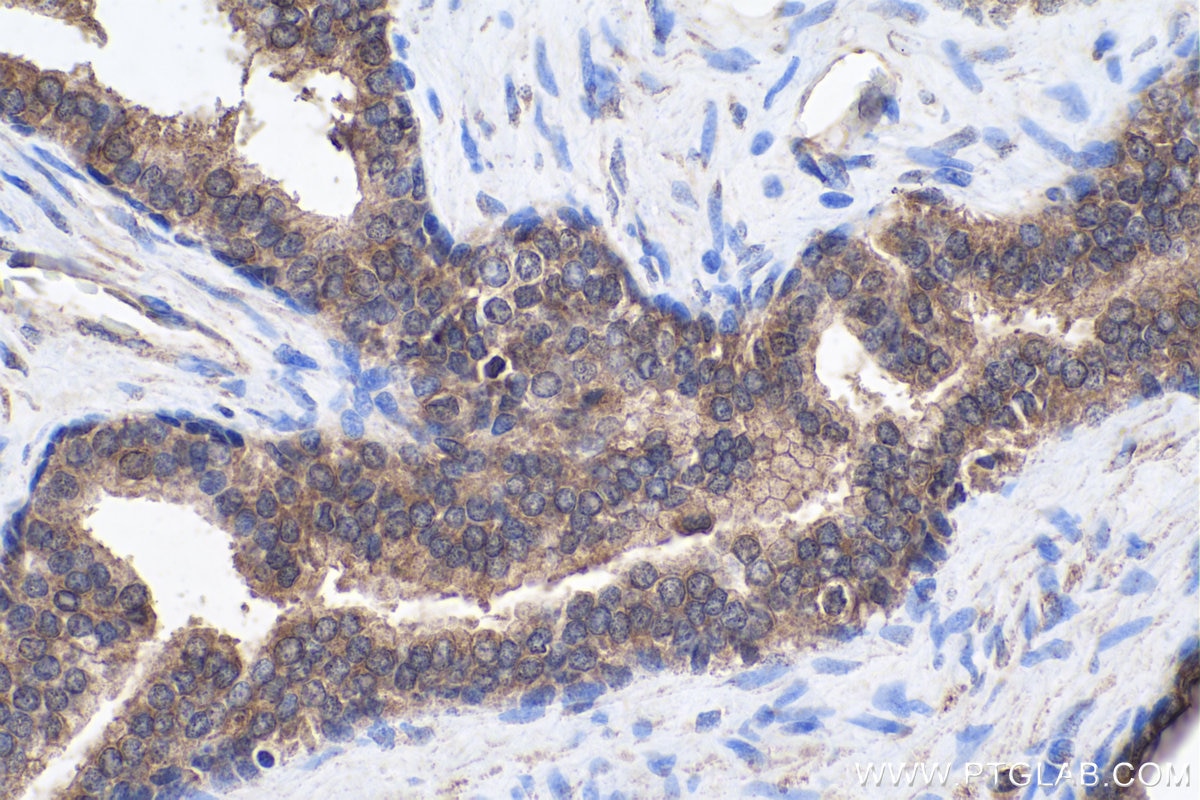 Immunohistochemical analysis of paraffin-embedded human prostate cancer tissue slide using KHC0228 (PLIN1 IHC Kit).
