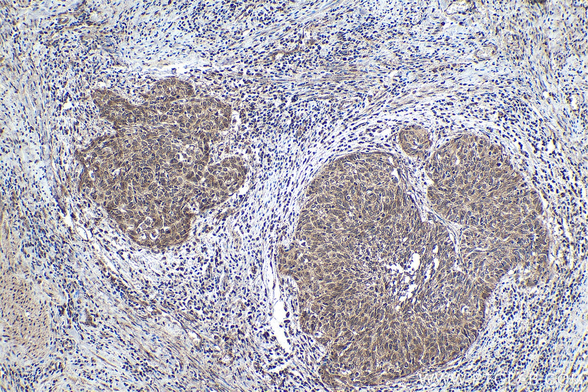 Immunohistochemical analysis of paraffin-embedded human cervical cancer tissue slide using KHC1624 (PLK1 IHC Kit).