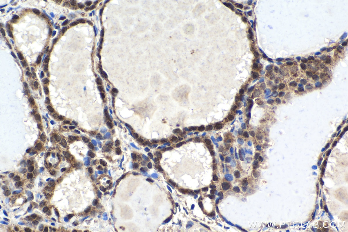 Immunohistochemical analysis of paraffin-embedded human thyroid cancer tissue slide using KHC1624 (PLK1 IHC Kit).