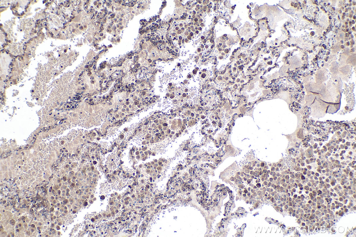 Immunohistochemical analysis of paraffin-embedded human lung tissue slide using KHC1931 (PLK3 IHC Kit).