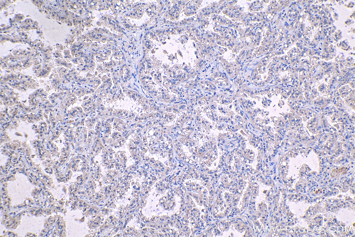 Immunohistochemical analysis of paraffin-embedded human lung cancer tissue slide using KHC1222 (PLK4 IHC Kit).