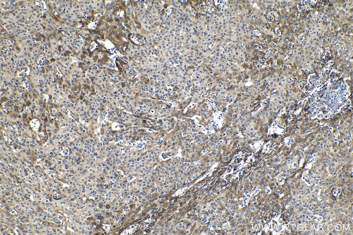 Immunohistochemical analysis of paraffin-embedded human cervical cancer tissue slide using KHC1240 (PLOD2 IHC Kit).