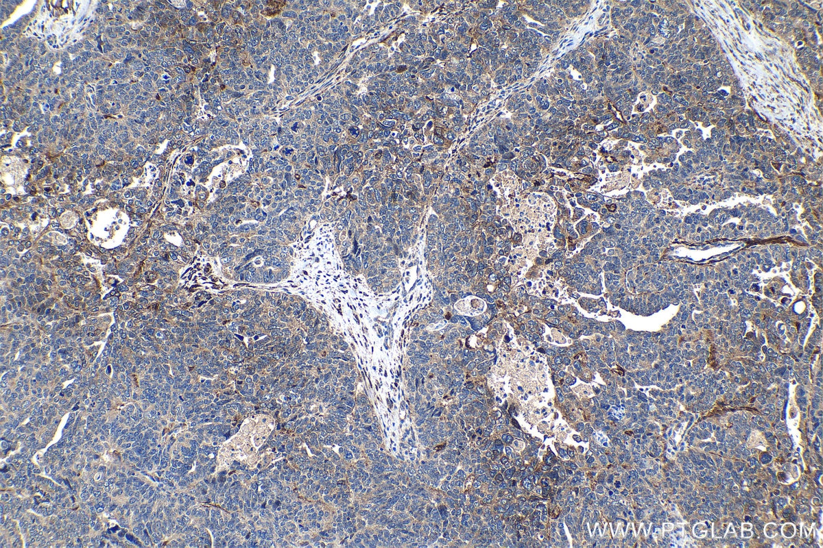 Immunohistochemical analysis of paraffin-embedded human ovary tumor tissue slide using KHC1240 (PLOD2 IHC Kit).