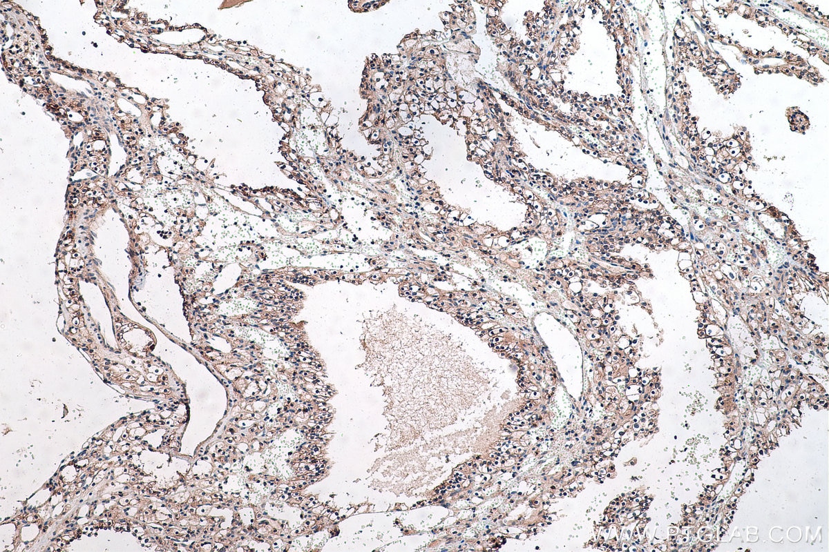 Immunohistochemical analysis of paraffin-embedded human renal cell carcinoma tissue slide using KHC0446 (PLP2 IHC Kit).