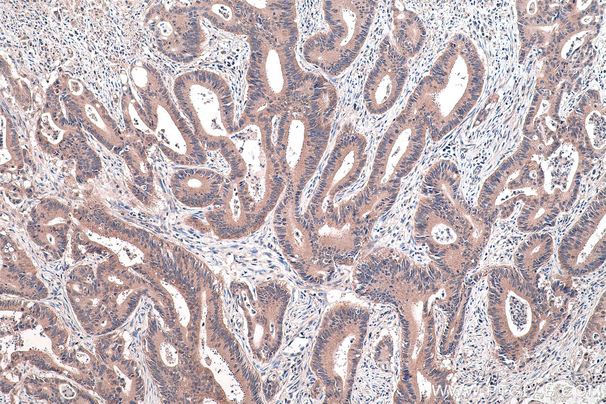 Immunohistochemical analysis of paraffin-embedded human colon cancer tissue slide using KHC0446 (PLP2 IHC Kit).