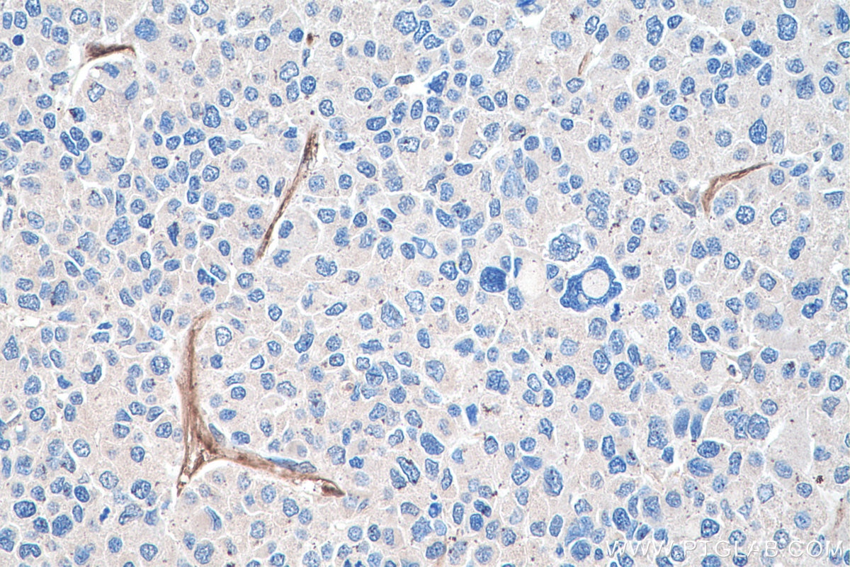 Immunohistochemical analysis of paraffin-embedded human liver cancer tissue slide using KHC0191 (PLVAP IHC Kit).