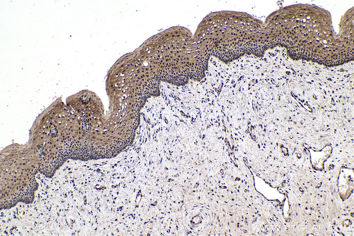 Immunohistochemical analysis of paraffin-embedded human cervical cancer tissue slide using KHC1576 (PML IHC Kit).