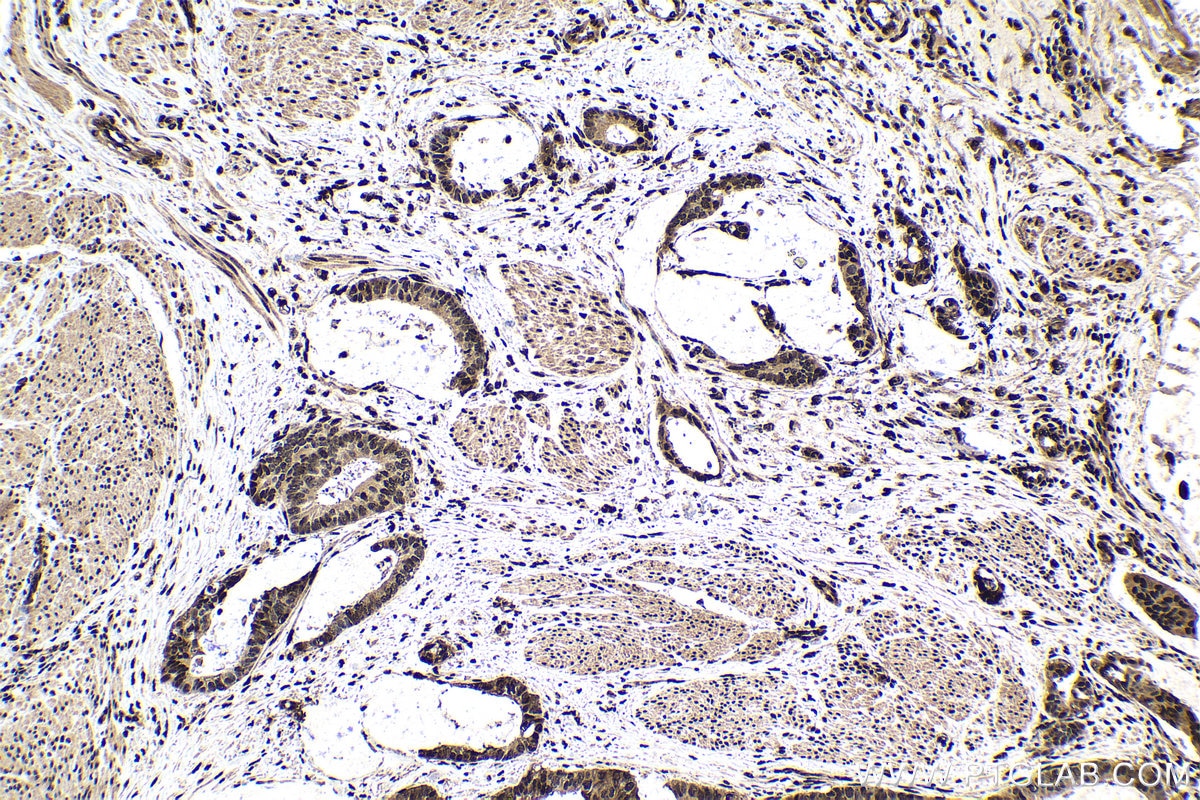 Immunohistochemical analysis of paraffin-embedded human urothelial carcinoma tissue slide using KHC1576 (PML IHC Kit).