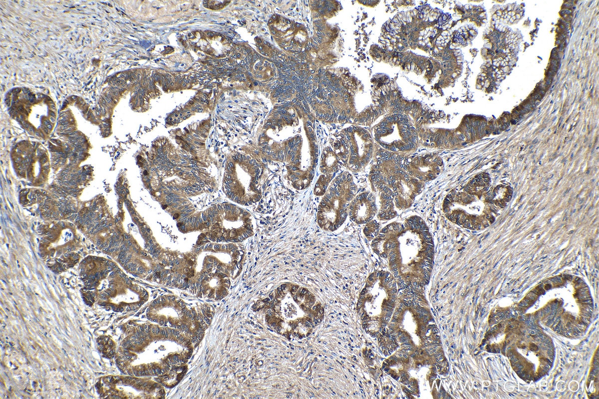 Immunohistochemical analysis of paraffin-embedded human pancreas cancer tissue slide using KHC1332 (PNLIP IHC Kit).