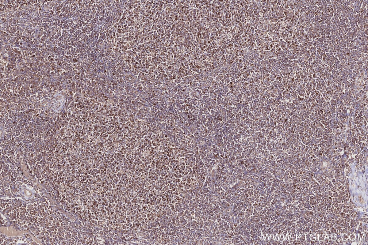 Immunohistochemical analysis of paraffin-embedded human tonsillitis tissue slide using KHC2713 (PNPT1 IHC Kit).