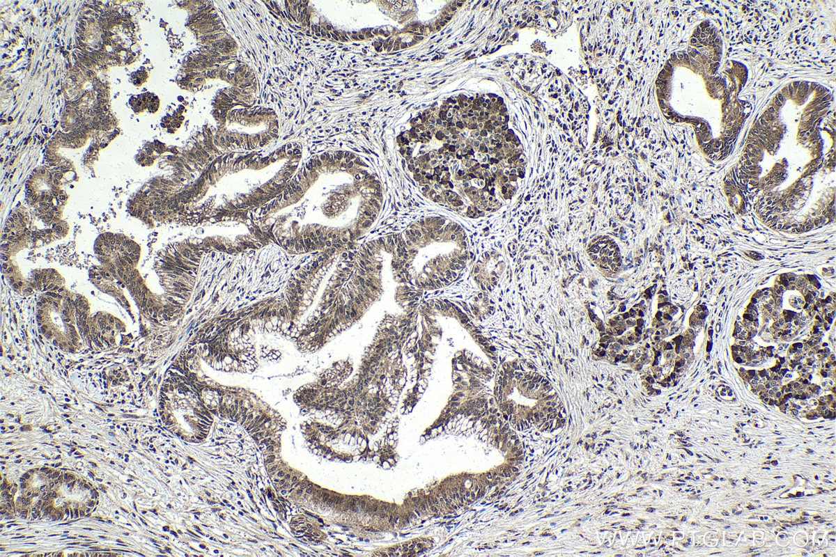 Immunohistochemical analysis of paraffin-embedded human pancreas cancer tissue slide using KHC1802 (POGZ IHC Kit).
