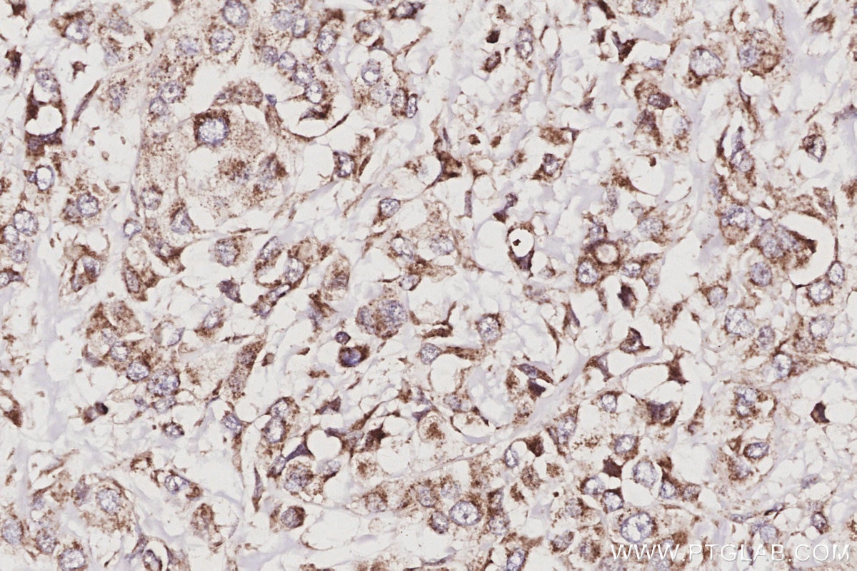 Immunohistochemical analysis of paraffin-embedded human breast cancer tissue slide using KHC3057 (POLDIP2 IHC Kit). Immunohistochemical analysis of paraffin-embedded human breast cancer tissue slide using KHC3057 (POLDIP2 IHC Kit).