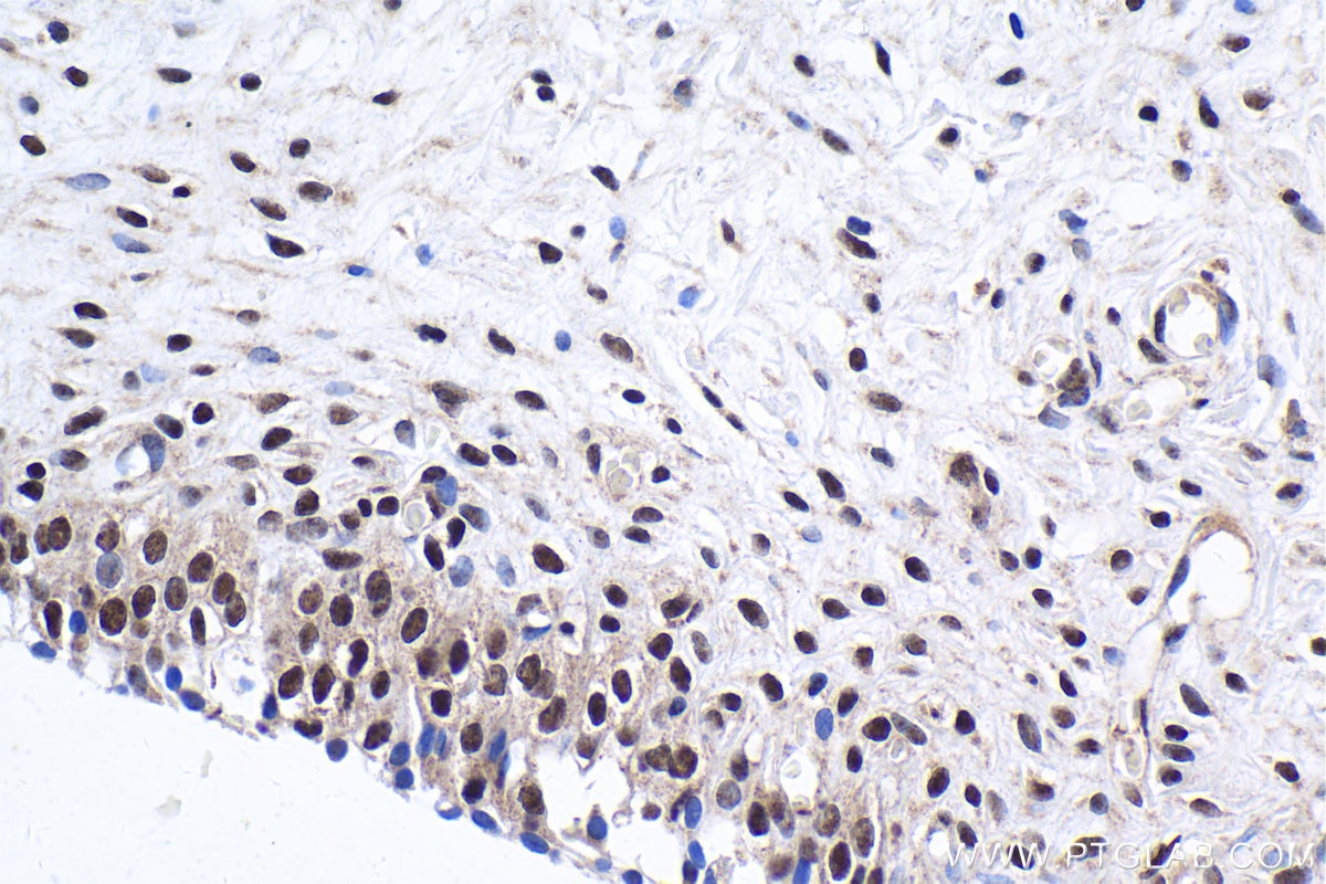 Immunohistochemical analysis of paraffin-embedded human urothelial carcinoma tissue slide using KHC1908 (POLDIP3/SKAR IHC Kit).