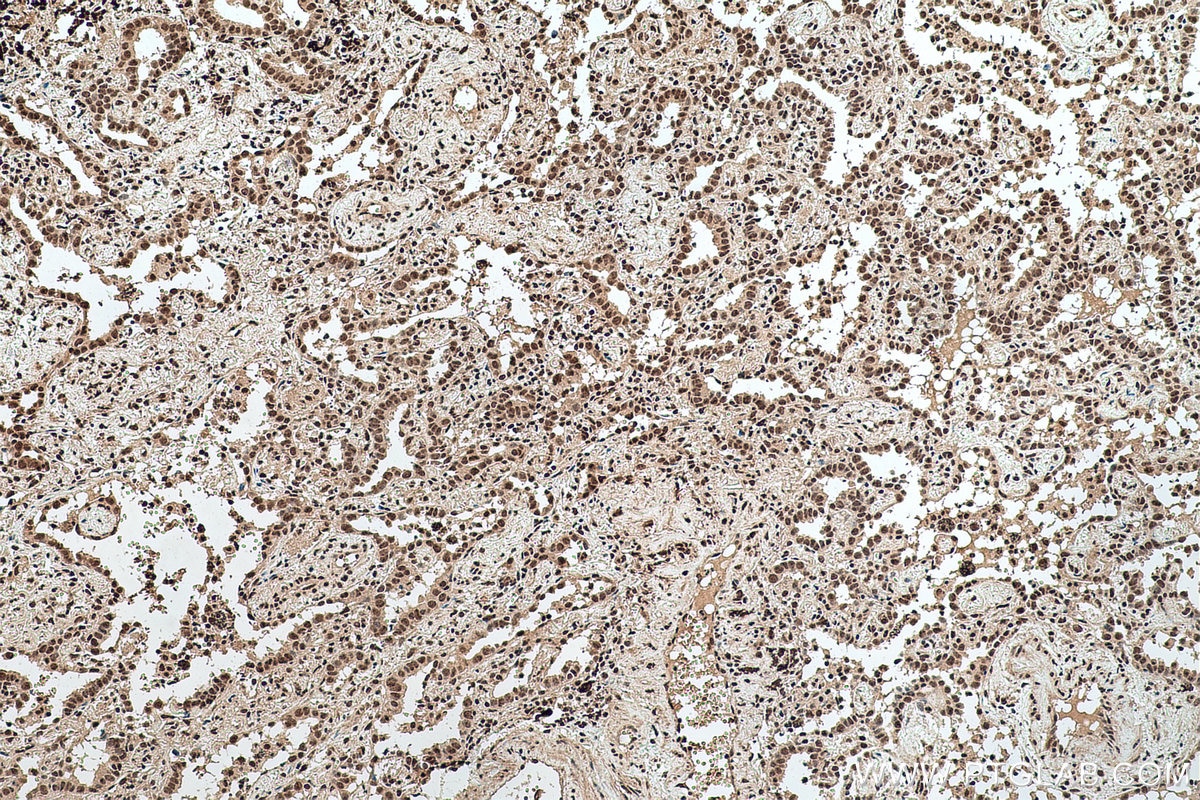 Immunohistochemical analysis of paraffin-embedded human lung cancer tissue slide using KHC0758 (POLE IHC Kit).