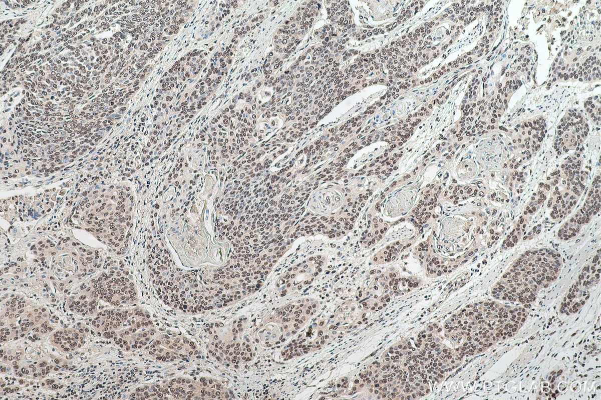 Immunohistochemical analysis of paraffin-embedded human oesophagus cancer tissue slide using KHC0758 (POLE IHC Kit).