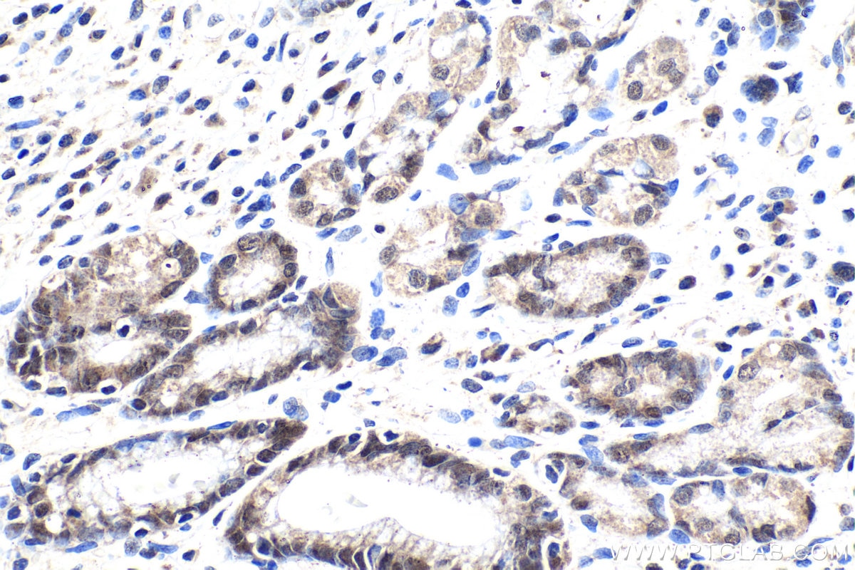 Immunohistochemical analysis of paraffin-embedded human stomach cancer tissue slide using KHC1918 (POLR1E IHC Kit).