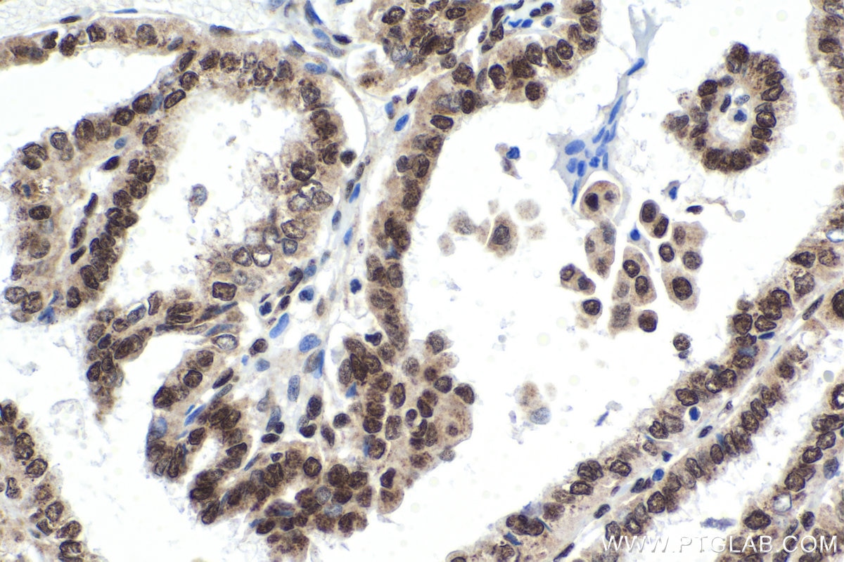 Immunohistochemical analysis of paraffin-embedded human thyroid cancer tissue slide using KHC1577 (POLR2B IHC Kit).