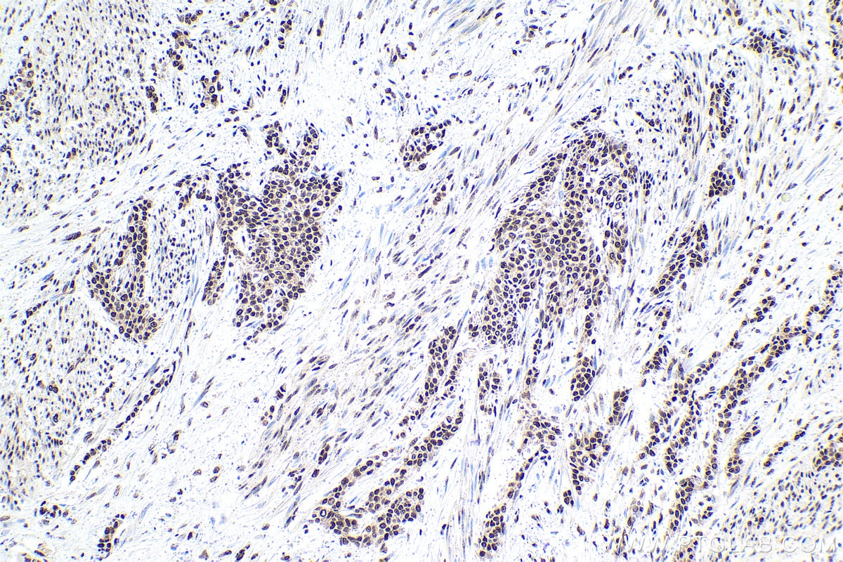 Immunohistochemical analysis of paraffin-embedded human urothelial carcinoma tissue slide using KHC1577 (POLR2B IHC Kit).