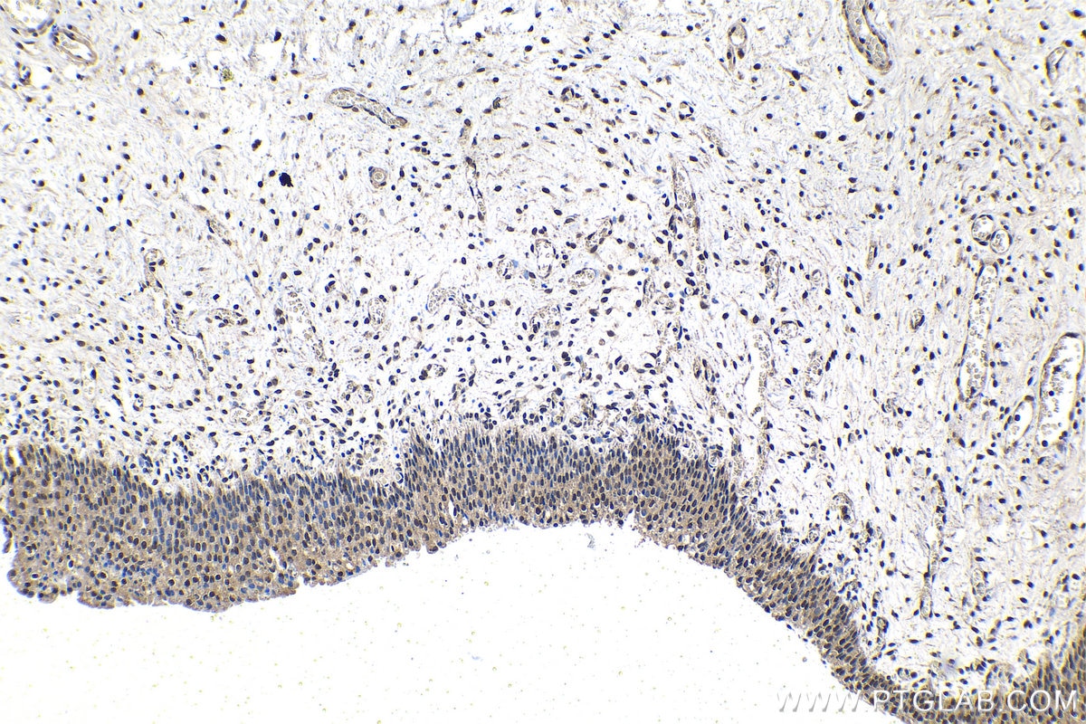 Immunohistochemical analysis of paraffin-embedded human urothelial carcinoma tissue slide using KHC1544 (POLR2C IHC Kit).
