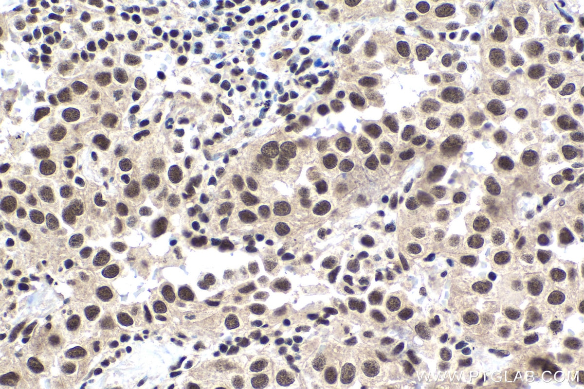 Immunohistochemical analysis of paraffin-embedded human lung cancer tissue slide using KHC1446 (POLR2D IHC Kit).