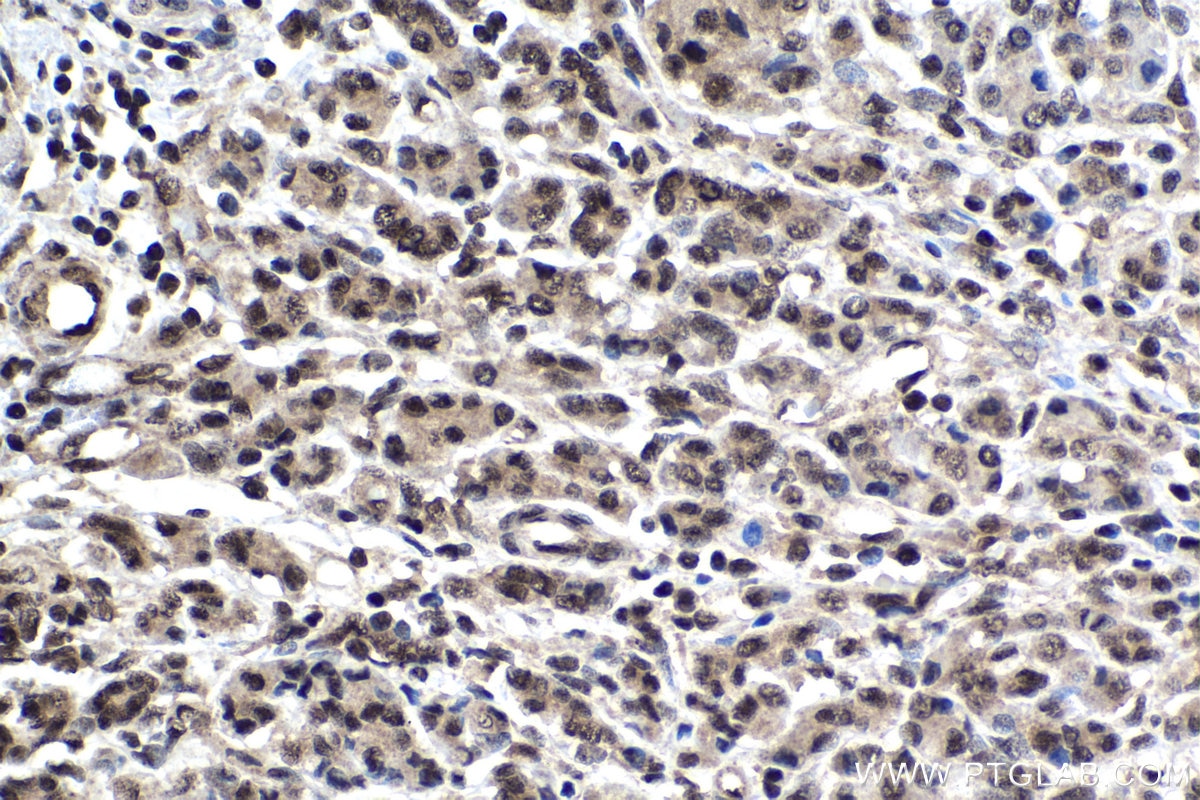 Immunohistochemical analysis of paraffin-embedded human pancreas cancer tissue slide using KHC1446 (POLR2D IHC Kit).