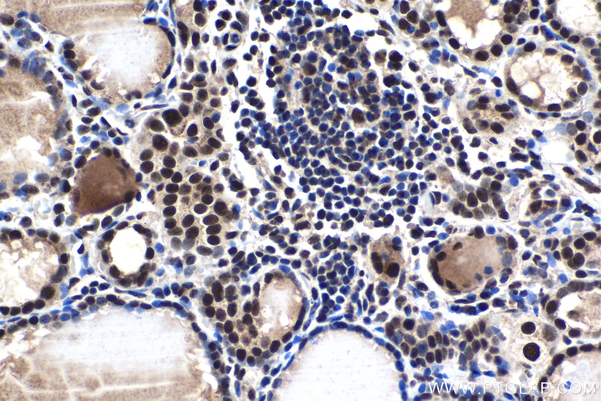 Immunohistochemical analysis of paraffin-embedded human thyroid cancer tissue slide using KHC1446 (POLR2D IHC Kit).