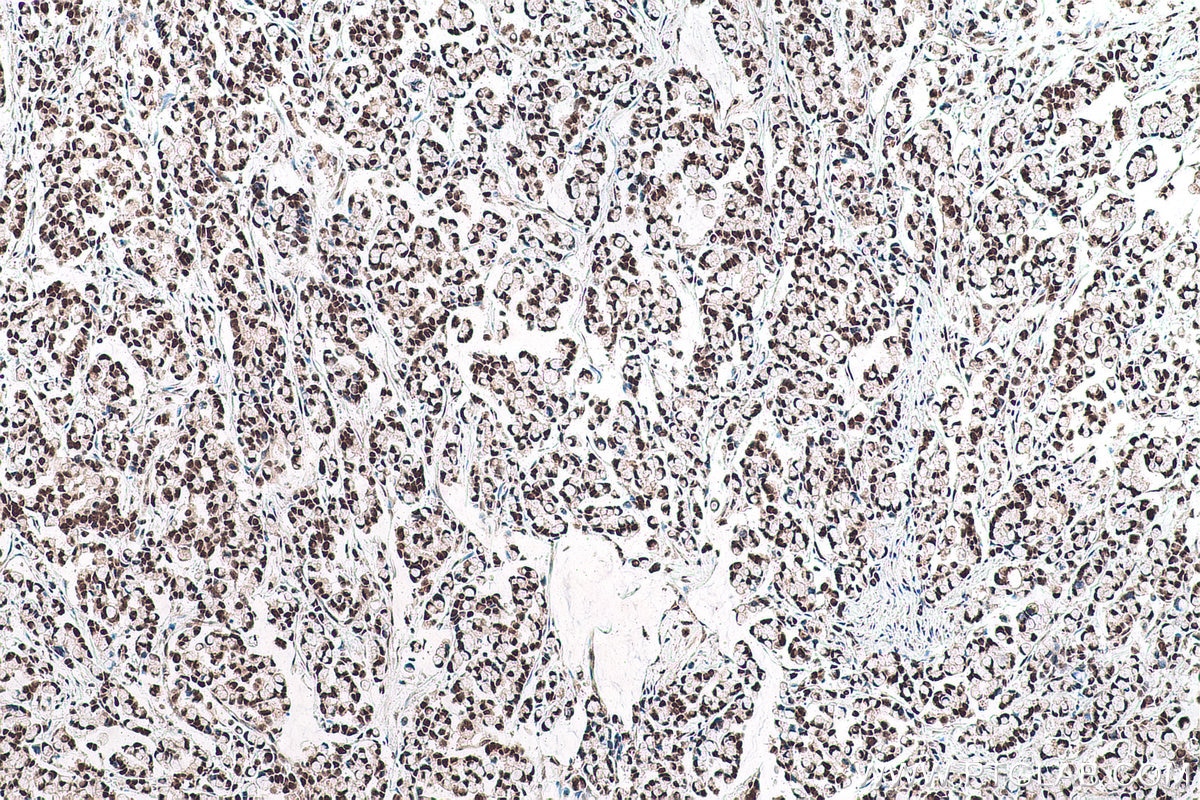 Immunohistochemical analysis of paraffin-embedded human colon cancer tissue slide using KHC0929 (POLR2E/RPB5 IHC Kit).