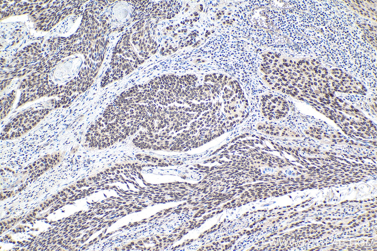 Immunohistochemical analysis of paraffin-embedded human oesophagus cancer tissue slide using KHC1640 (POLR2F IHC Kit).