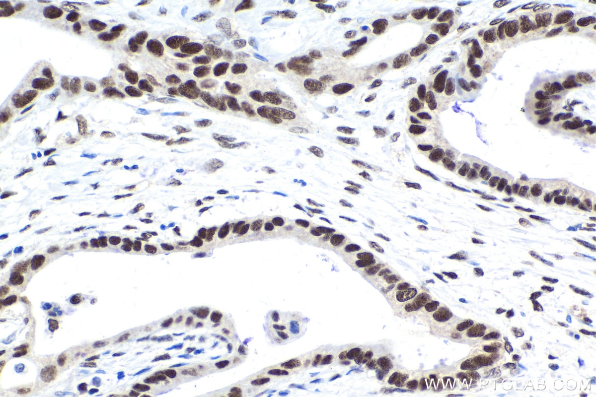 Immunohistochemical analysis of paraffin-embedded human urothelial carcinoma tissue slide using KHC1640 (POLR2F IHC Kit).