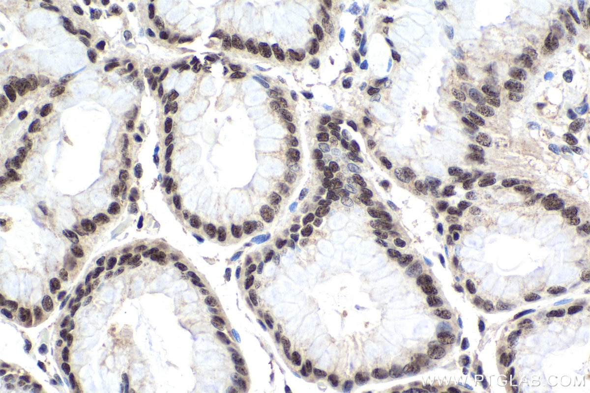 Immunohistochemical analysis of paraffin-embedded human stomach cancer tissue slide using KHC1600 (POLR2I IHC Kit).
